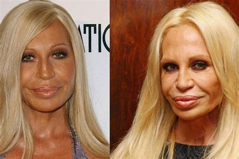 donatella versace antes de las cirugías